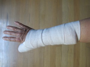 back of my hand view with temporary splint