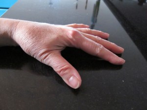 2nd hand surgery hand ready for surgery