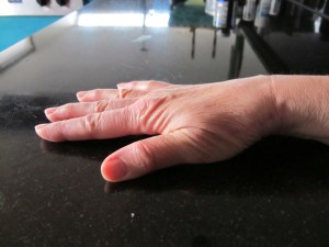 2nd hand surgery hand which had sugery in June