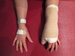 2nd hand surgery after surgery