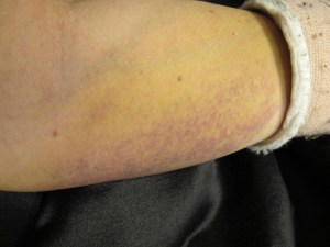 cast time - L bruising