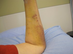 cast time - L more bruising