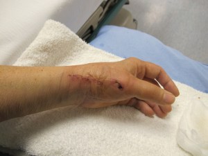 949-cast-2012-02-27 incision